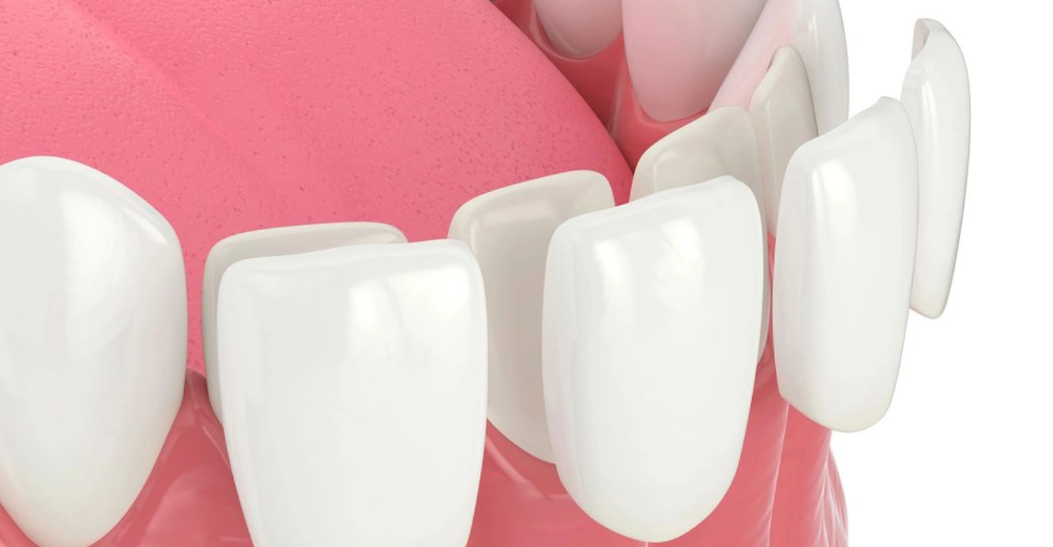 Risks of Veneers Inblog